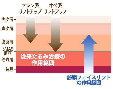 筋膜フェイスリフトの作用範囲