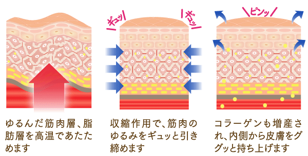 筋膜フェイスリフトのたるみ引き上げイメージ