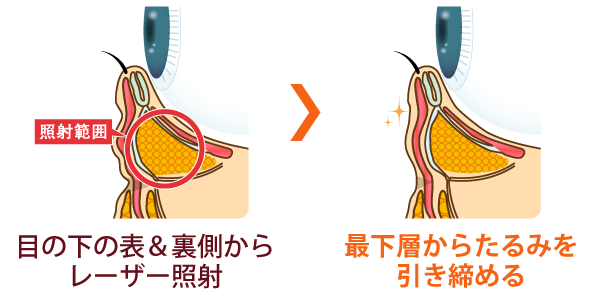 筋膜サーマダブルアイズの効果イメージ