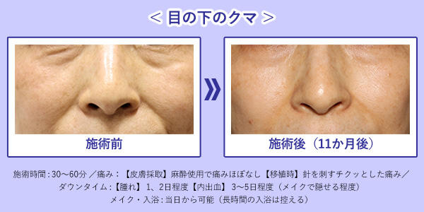 真皮線維芽細胞療法による目の下のクマ治療