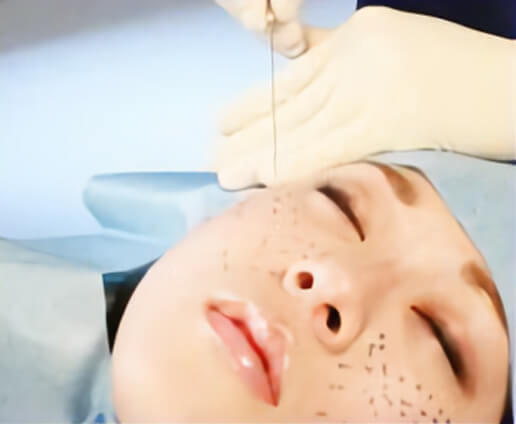 『3Dリフトロング』の挿入