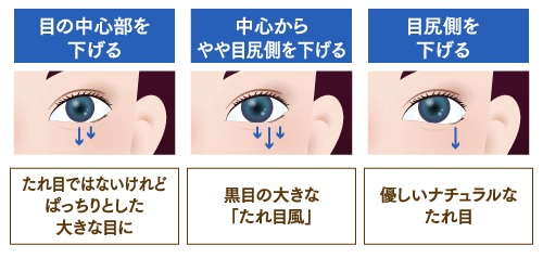 タレ目 でか目形成 公式 オザキクリニック 美容整形 美容外科 美容皮膚科 東京新宿 目黒祐天寺 羽村