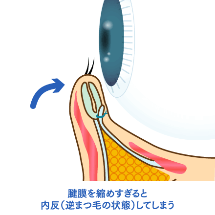 たれ目・でか目形成の施術概要のイメージ