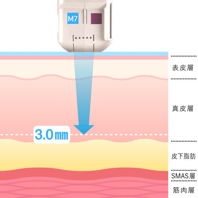 HIFU治療でハリ感アップ！