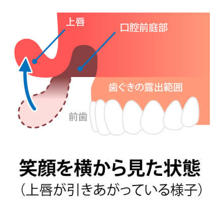ガミースマイルの主な原因のイメージ