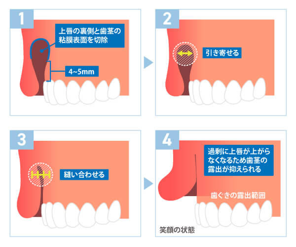 口腔内粘膜切除術の治療イメージ