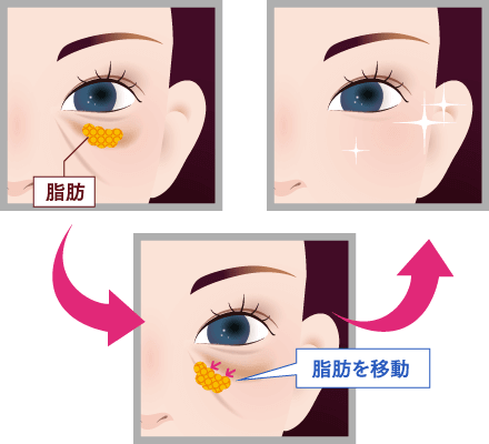 ハムラ法（目の下のたるみ取り）で目元の印象が明るくなるイメージ