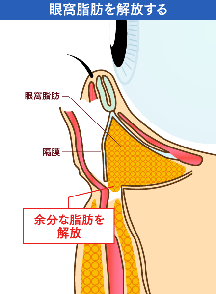 眼窩脂肪を解放するイメージ