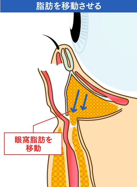 脂肪を移動させるイメージ