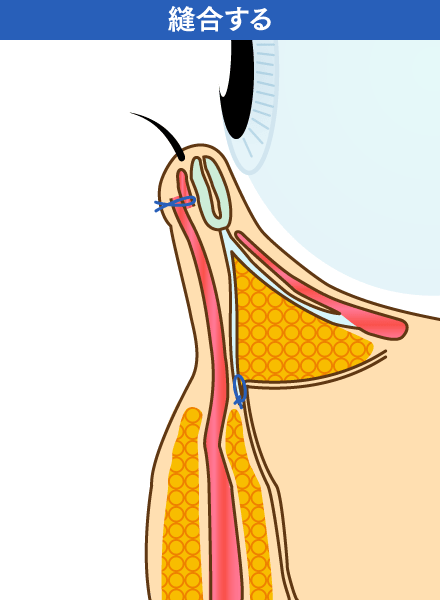縫合するイメージ