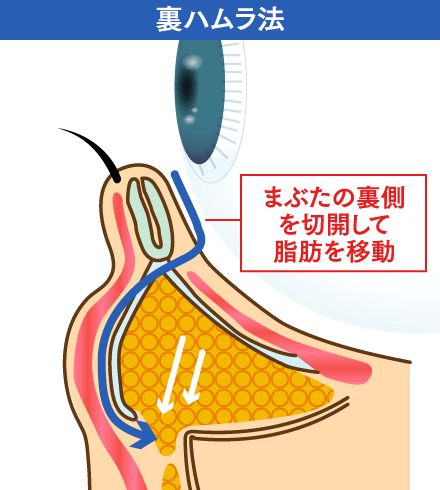 裏ハムラ法のイメージ
