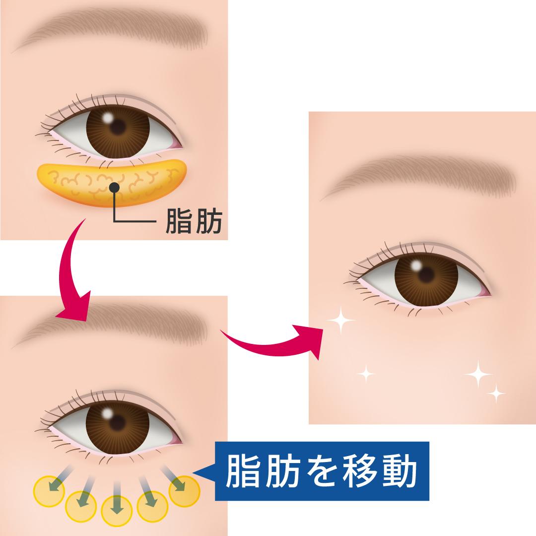 ハムラ法・裏ハムラ法図解