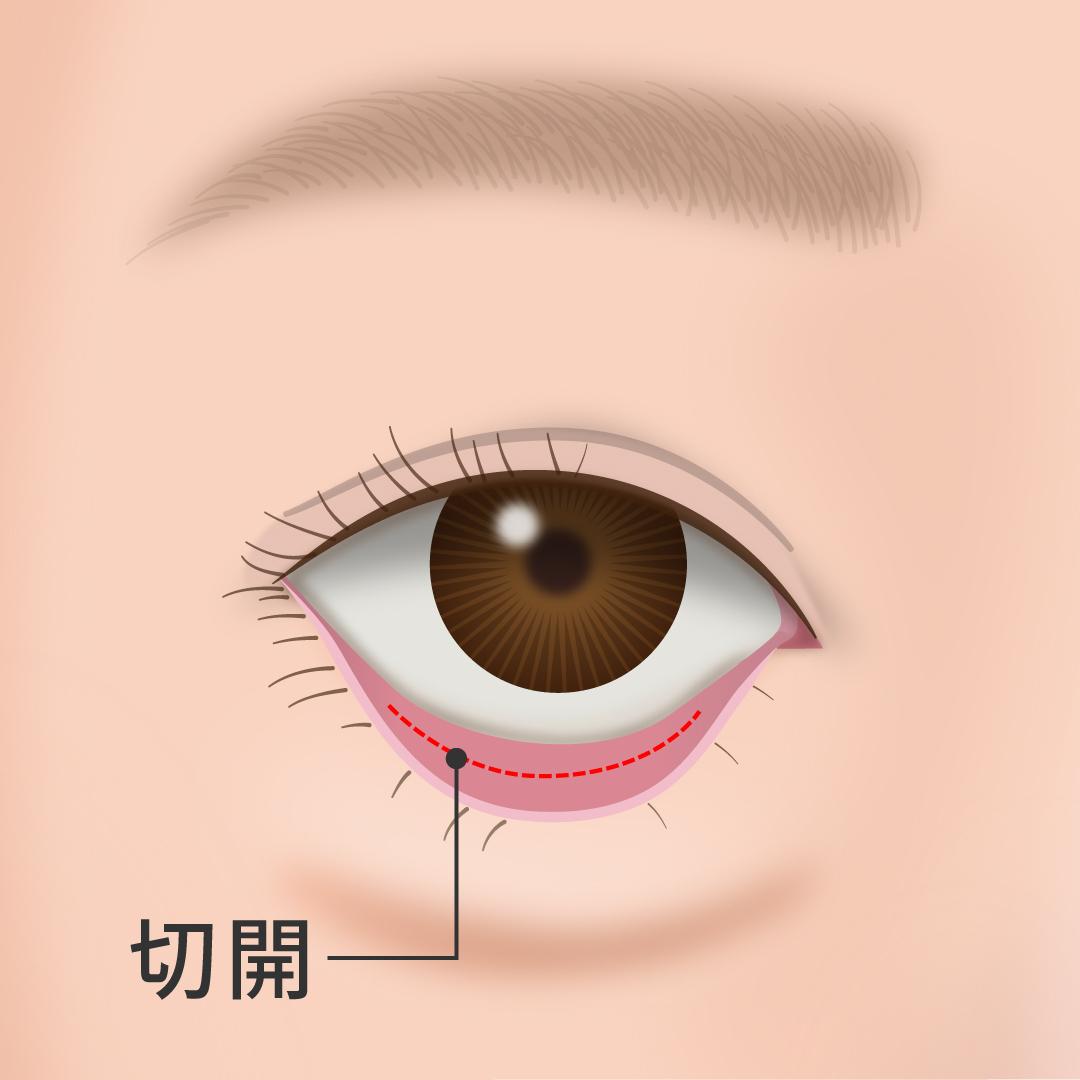 裏ハムラ法切開線