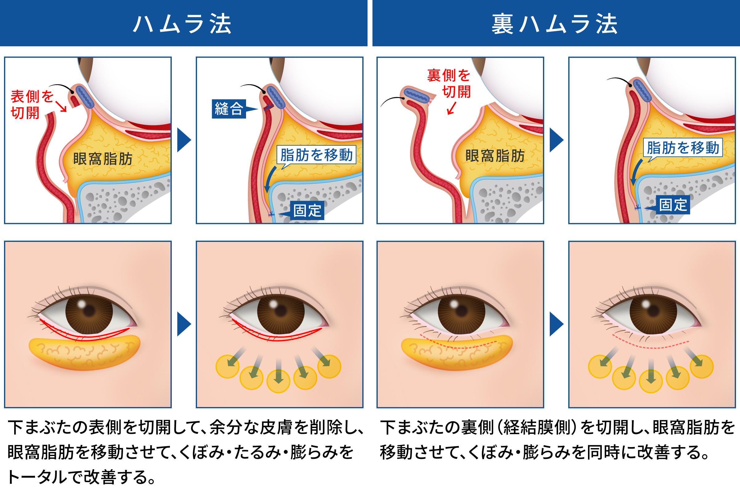ハムラ法と裏ハムラ法の違い