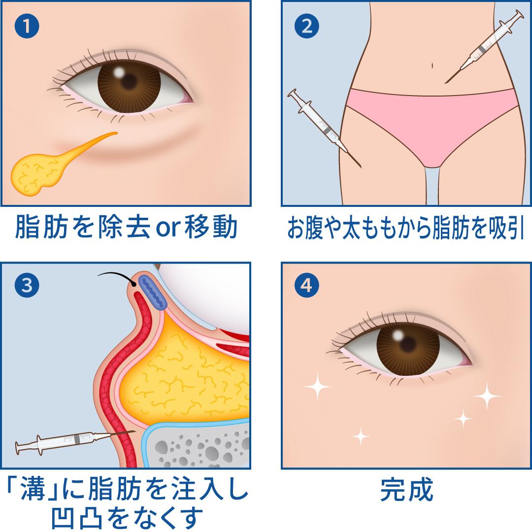 脂肪注入