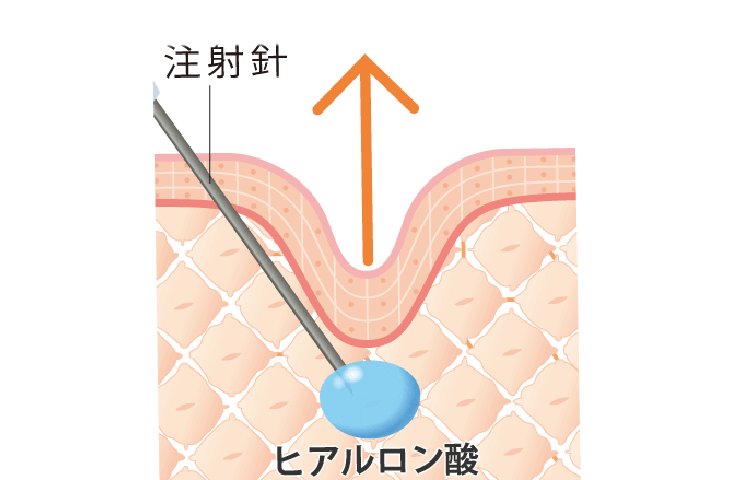 ヒアルロン酸注射の注入