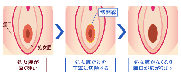 処女膜 湘南美容クリニック豊田院院長だい先生のブログ - はてなブログ