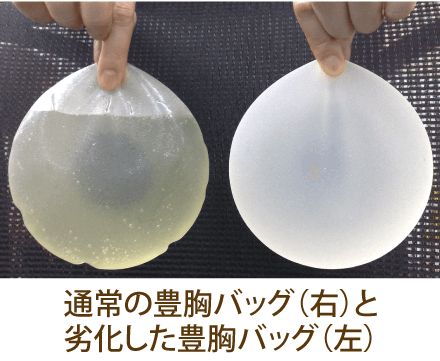 通常の豊胸バッグ(右)と劣化した豊胸バッグ(左)の違い