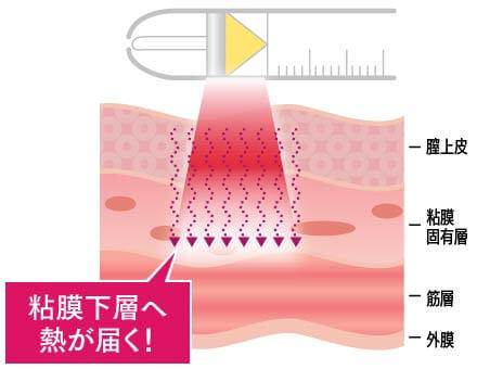 粘膜下層へ熱が届くイメージ