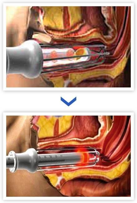 尿漏れ治療イメージ