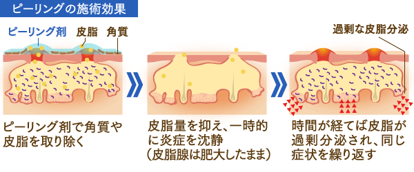 ピーリングの治療効果