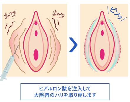 大陰唇増大術 ヒアルロン酸注入 公式 オザキクリニック 大陰唇増大術 ヒアルロン酸注入 公式 オザキクリニック