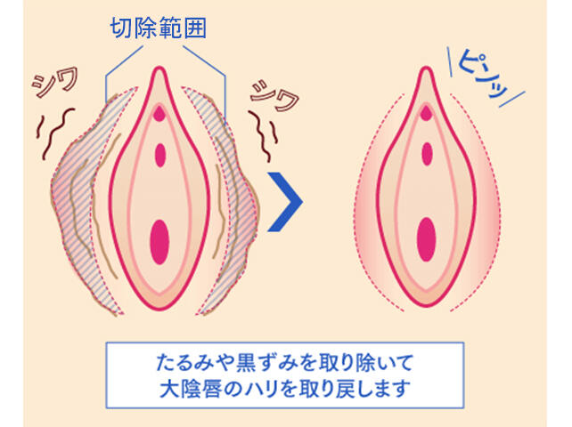 陰茎 皮 たるみ