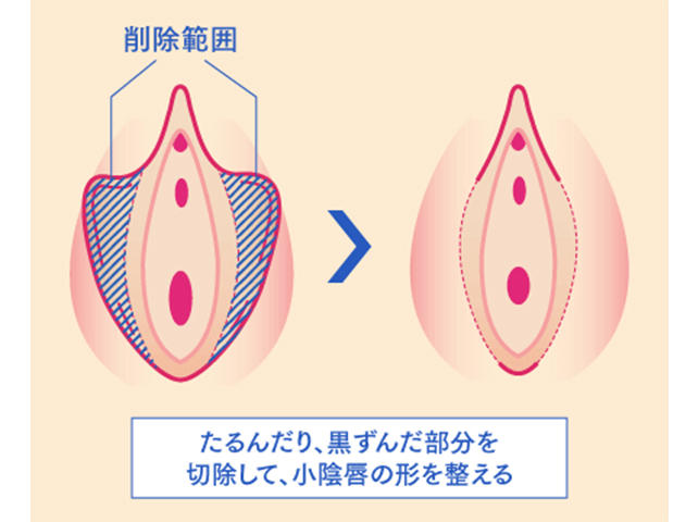 いん しん 縮小 適用 しょう 手術 保険 小陰唇や膣縮小などの婦人科形成治療