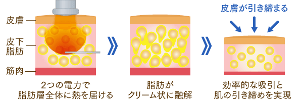 ボディタイトのイメージ