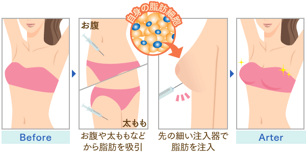 脂肪注入豊胸のイメージ