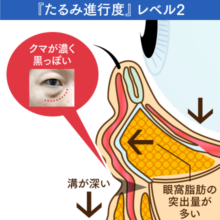 たるみ進行度レベル2のイメージ