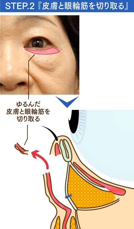 STEP2 皮膚と眼輪筋を切り取るのイメージ