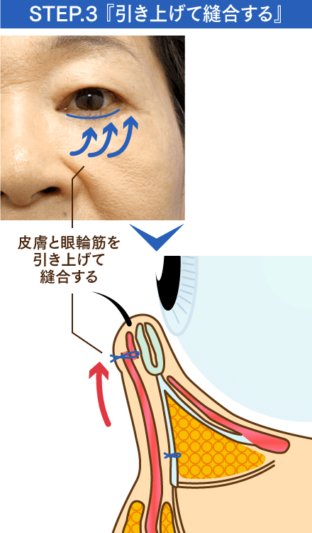 STEP3 引き上げて縫合するのイメージ