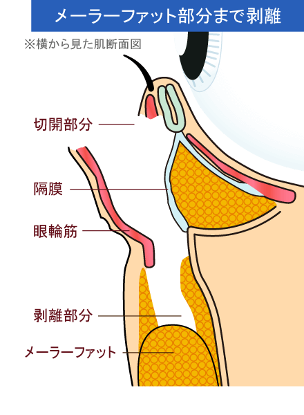 ミッドフェイスリフト 公式 オザキクリニック ミッドフェイスリフト 公式 オザキクリニック