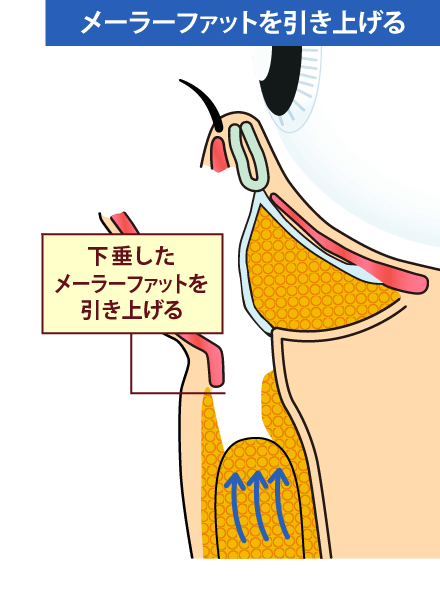 ミッドフェイスリフトのイメージ