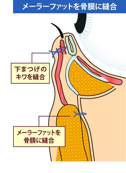 ミッドフェイスリフトのイメージ