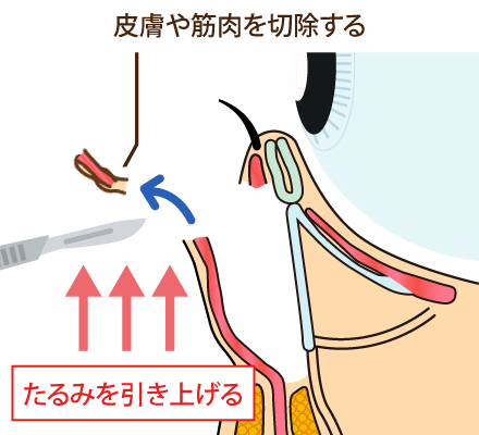 ミッドフェイスリフトの持続効果とリフトアップ力のイメージ