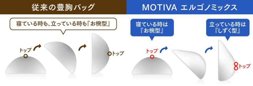 Motiva Ergonomix（モティバ エルゴノミックス）と従来の豊胸バッグの違い