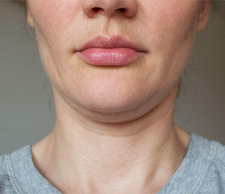 フェイスラインや二重あごのたるみのイメージ