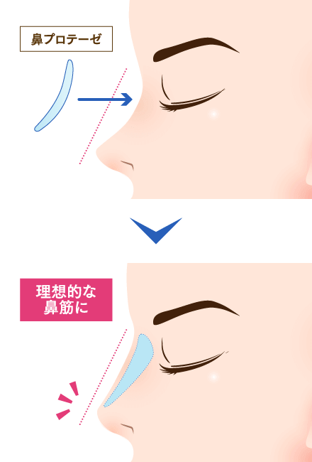 理想の鼻に合わせて施術をセレクトする鼻整形 特徴や効果 症例写真 施術の流れ解説 公式 オザキクリニック