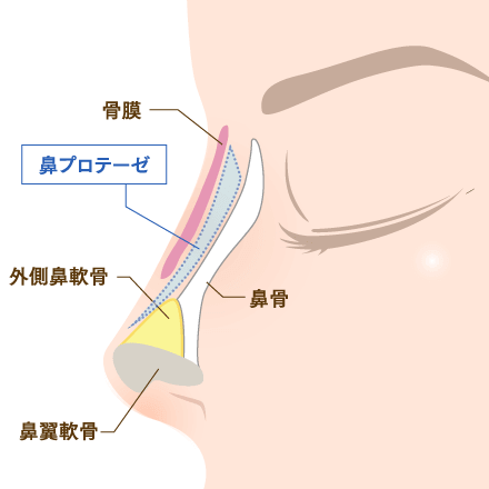 I型の鼻プロテーゼのイメージ