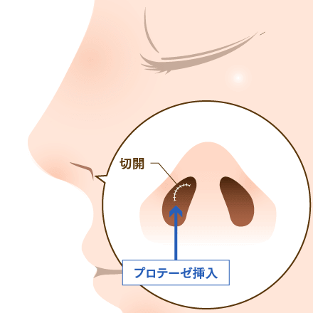 鼻プロテーゼの挿入イメージ