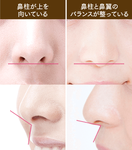鼻中隔延長のイメージ