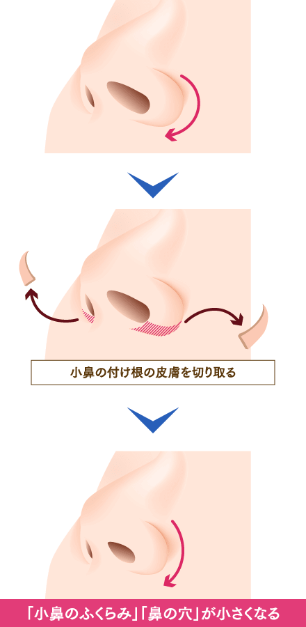 大きい小鼻の治療イメージ