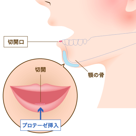 顎プロテーゼ（顎整形）のイメージ