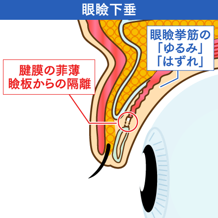 眼瞼下垂の症状のイメージ