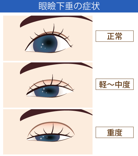 眼瞼下垂の症状のイメージ