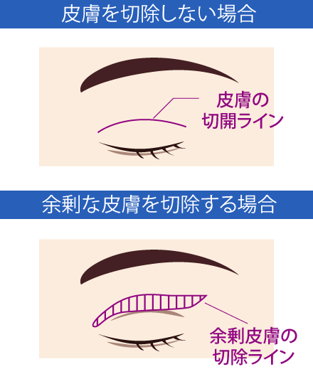 眼瞼下垂のデザインのイメージ