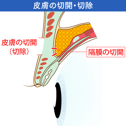 眼瞼下垂の皮膚の切開・切除イメージ