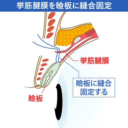 眼瞼下垂の挙筋腱膜を瞼板に縫合固定するイメージ